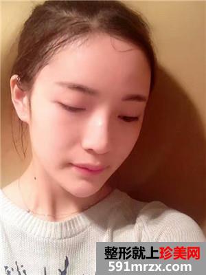 自体脂肪丰额头和太阳穴效果对比照和恢复过程