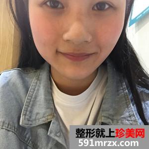 玻尿酸注射瘦脸除咬肌案例分享还有对比照片哦