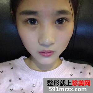 玻尿酸注射瘦脸除咬肌案例分享还有对比照片哦