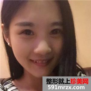 玻尿酸注射瘦脸除咬肌案例分享还有对比照片哦