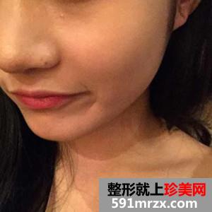 玻尿酸注射瘦脸除咬肌案例分享还有对比照片哦
