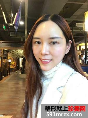 自体脂肪填充全脸效果图片和恢复经历