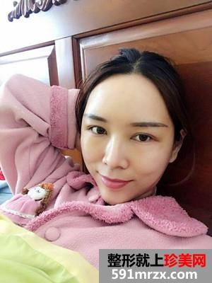 自体脂肪填充全脸效果图片和恢复经历