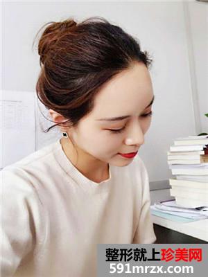 自体脂肪填充全脸效果图片和恢复经历