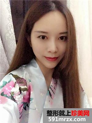 自体脂肪填充全脸效果图片和恢复经历