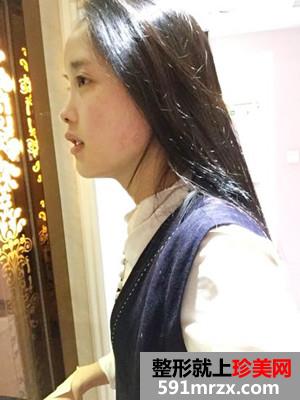 鼻综合手术恢复记录还有效果图哦