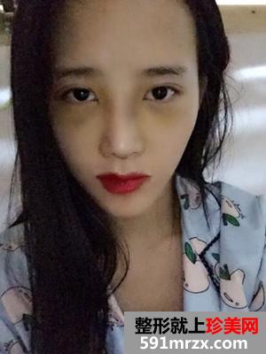 鼻综合手术恢复记录还有效果图哦