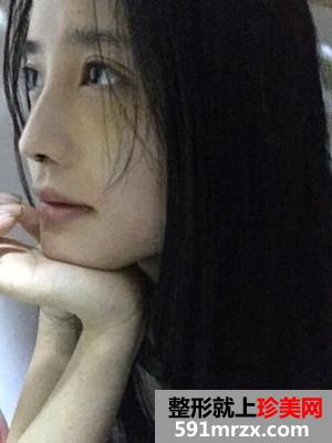 鼻综合手术恢复记录还有效果图哦