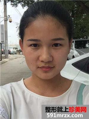 水光嫩肤补水前后对比照片和术后恢复