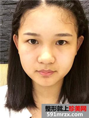 水光嫩肤补水前后对比照片和术后恢复