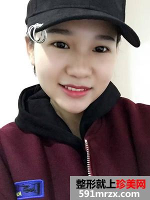 水光嫩肤补水前后对比照片和术后恢复
