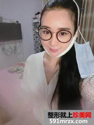 面部下巴吸脂恢复情况和前后对比图