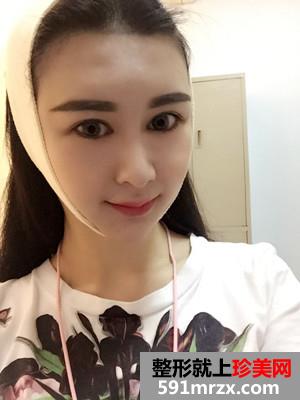 面部下巴吸脂恢复情况和前后对比图