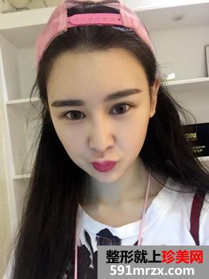 面部下巴吸脂恢复情况和前后对比图