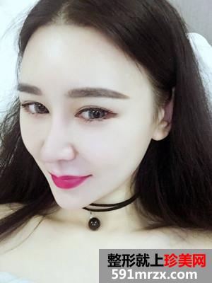 面部下巴吸脂恢复情况和前后对比图