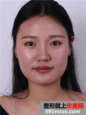 玻尿酸丰下巴术后恢复情况分享