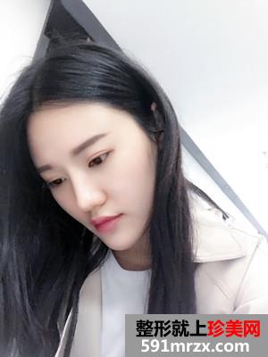 玻尿酸丰下巴术后恢复情况分享