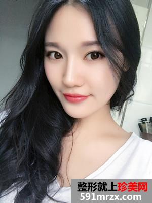玻尿酸丰下巴术后恢复情况分享