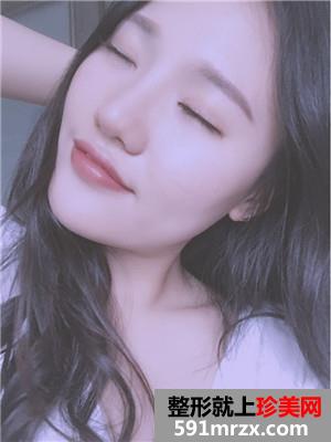 玻尿酸丰下巴术后恢复情况分享