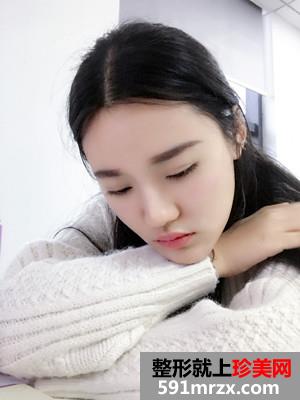 玻尿酸丰下巴术后恢复情况分享