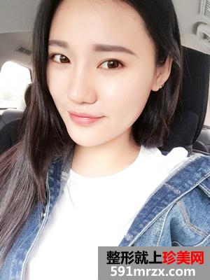 玻尿酸丰下巴术后恢复情况分享