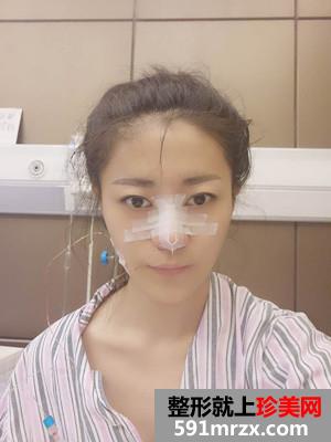 鼻综合手术+双眼皮恢复过程还有前后对比图