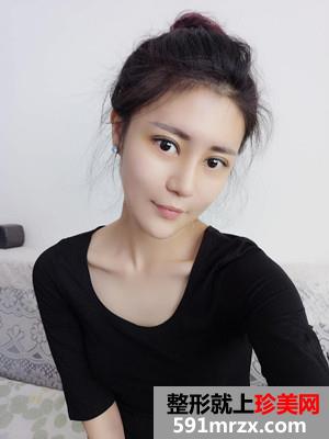 鼻综合手术+双眼皮恢复过程还有前后对比图