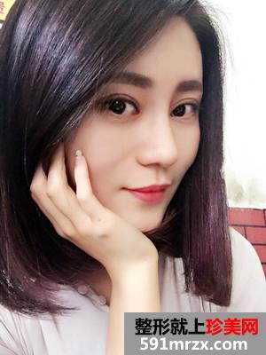 鼻综合手术+双眼皮恢复过程还有前后对比图