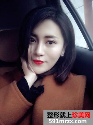 鼻综合手术+双眼皮恢复过程还有前后对比图