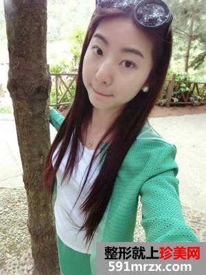 鼻综合+自体脂肪丰苹果肌整形日记分享还有前后照片对比哦