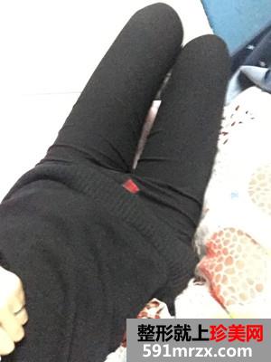 激光溶脂瘦腿术前后对比照还有恢复过程经历