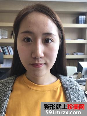 自体脂肪填充面部术后恢复记录还有前后对比照哦