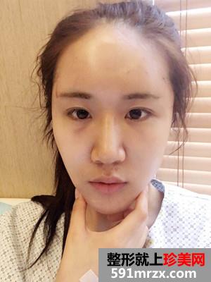 自体脂肪填充面部术后恢复记录还有前后对比照哦