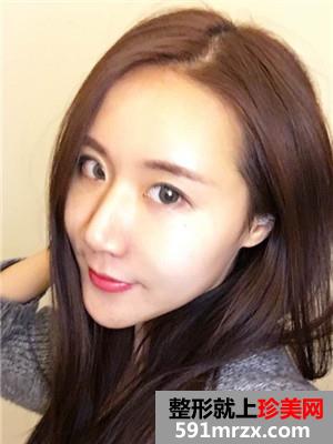 自体脂肪填充面部术后恢复记录还有前后对比照哦