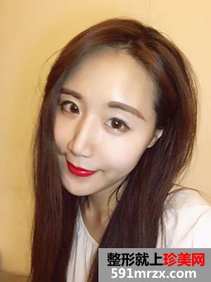 自体脂肪填充面部术后恢复记录还有前后对比照哦