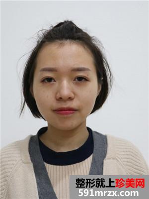 鼻翼缩小+硅胶假体隆鼻恢复过程记录和前后效果图对比