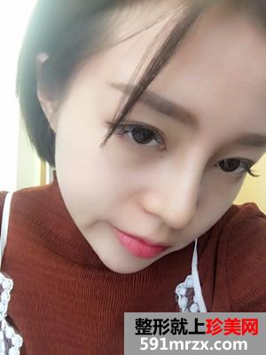 鼻翼缩小+硅胶假体隆鼻恢复过程记录和前后效果图对比