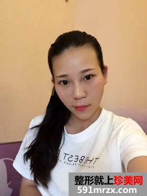 全切双眼皮+自体脂肪丰苹果肌恢复日记还有前后照片对比