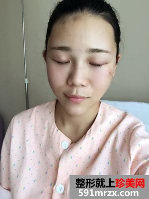 全切双眼皮+自体脂肪丰苹果肌恢复日记还有前后照片对比