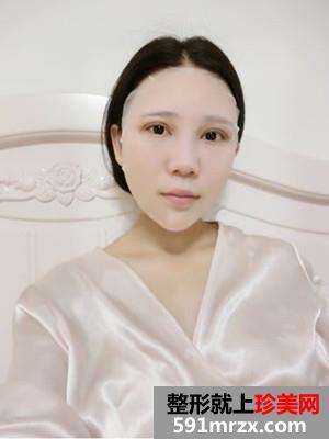 全切双眼皮+自体脂肪丰苹果肌恢复日记还有前后照片对比