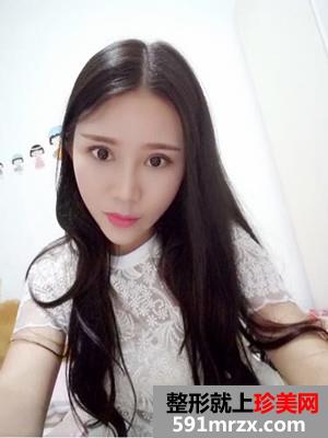全切双眼皮+自体脂肪丰苹果肌恢复日记还有前后照片对比