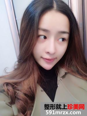 鼻综合失败修复手术恢复全过程与前后照对比