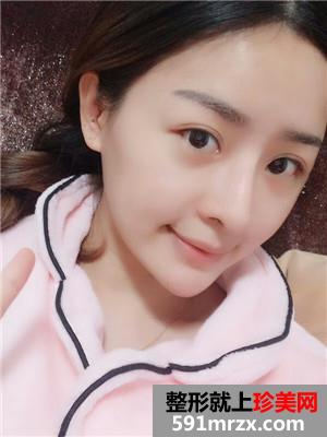 鼻综合失败修复手术恢复全过程与前后照对比
