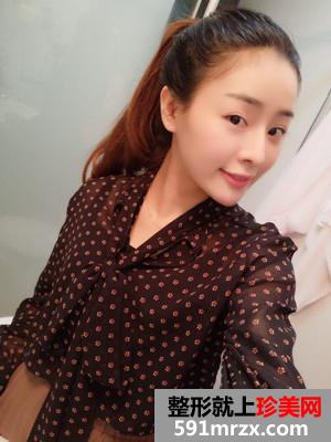 鼻综合失败修复手术恢复全过程与前后照对比