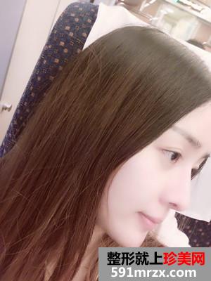 鼻综合失败修复手术恢复全过程与前后照对比
