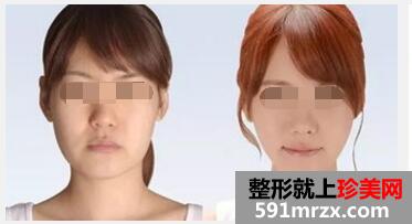 重庆面部注射溶脂针多少钱一针