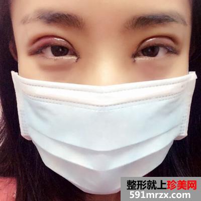 韩式全切双眼皮和开内眼角手术恢复过程分享附前后对比图