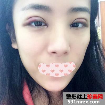 韩式全切双眼皮和开内眼角手术恢复过程分享附前后对比图
