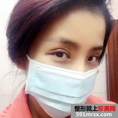 韩式全切双眼皮和开内眼角手术恢复过程分享附前后对比图