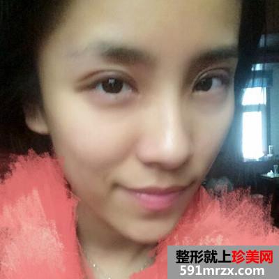 韩式全切双眼皮和开内眼角手术恢复过程分享附前后对比图